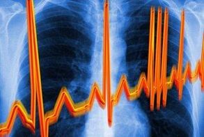 Arythmie cardiaque pour l'ostéochondose