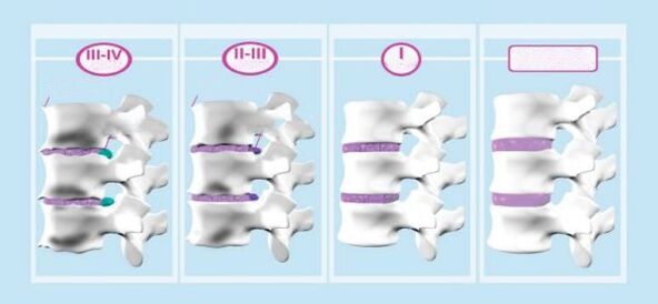 Phase de l'ostéochondose cervicale