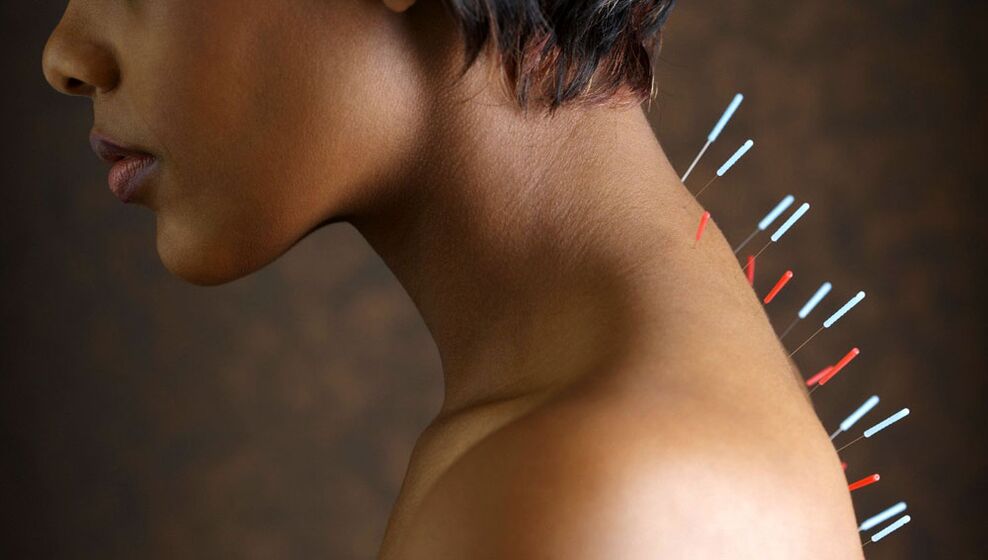 acupuncture avec ostéochondose cervicale