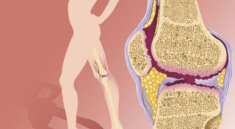 l'excès de poids conduit à l'arthrose