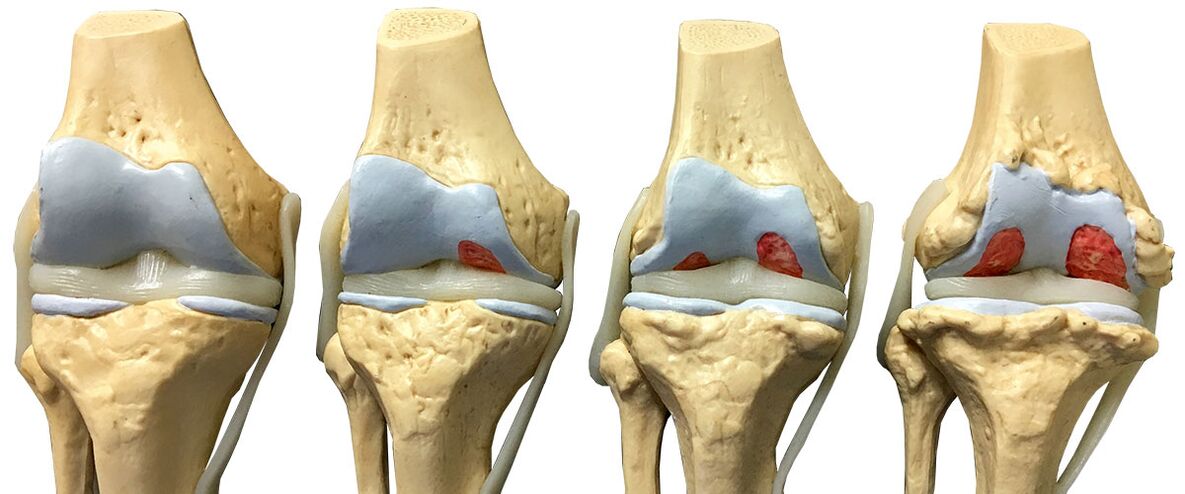 Phase d'arthrose